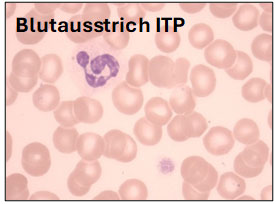 Blutausstrich ITP